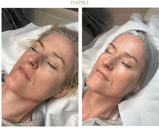 HydraFacial treatment - before and after results