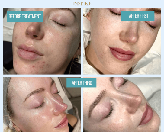 Set of skin treatments at Inspire Beauty