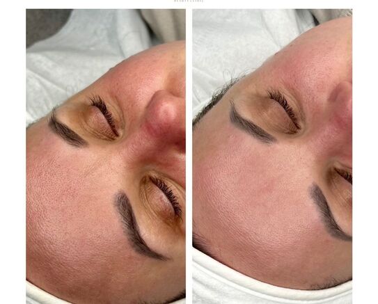 Microdermabrasion at Inspire Beauty