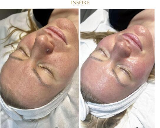 Hydrafacial treatment at Inspire Beauty